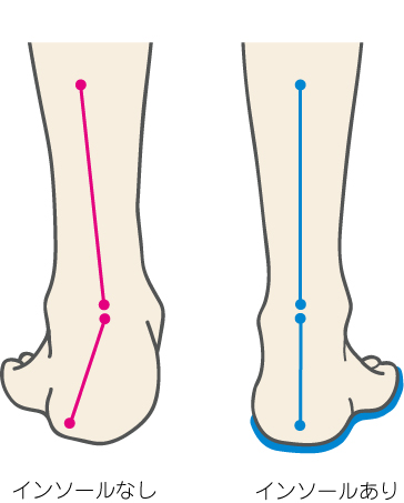 インソールの有無の足アライメント